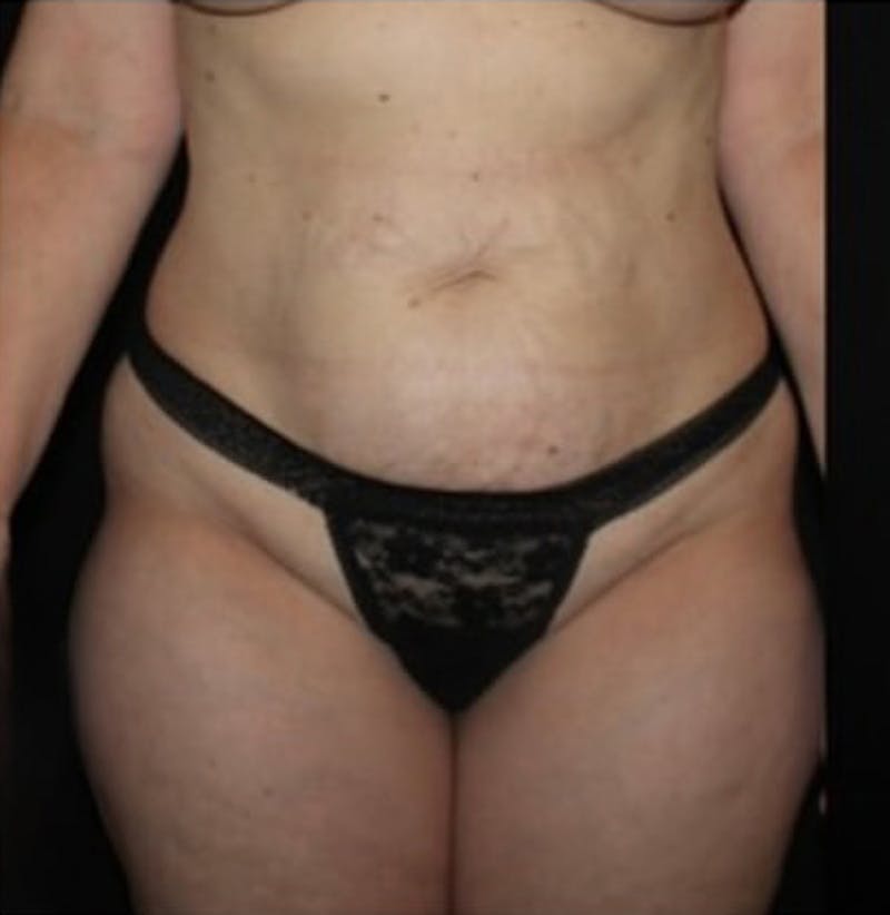 Tummy Tuck Before & After Gallery - Patient 513196 - Image 1