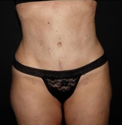 Tummy Tuck Before & After Gallery - Patient 513196 - Image 2