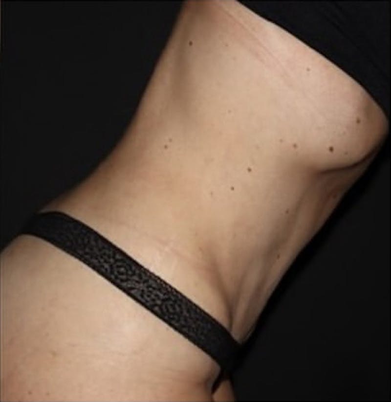 Tummy Tuck Before & After Gallery - Patient 513196 - Image 4
