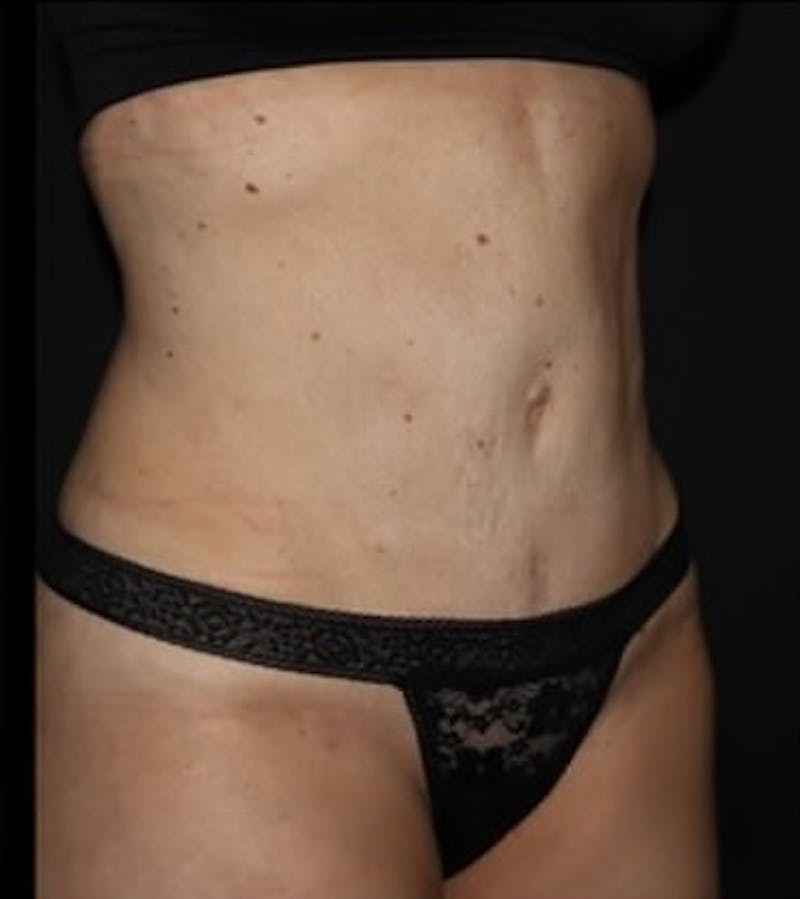 Tummy Tuck Before & After Gallery - Patient 513196 - Image 6
