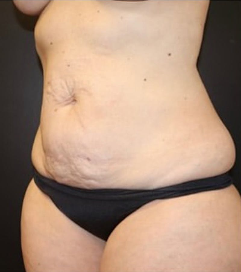 Tummy Tuck Before & After Gallery - Patient 513196 - Image 7