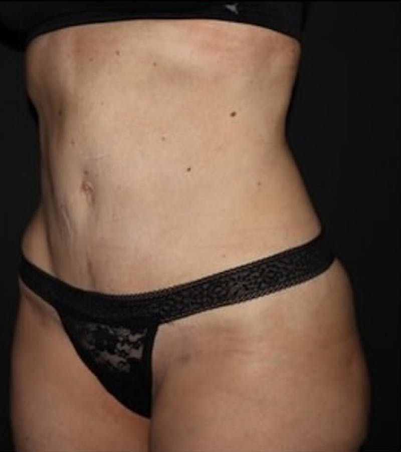 Tummy Tuck Before & After Gallery - Patient 513196 - Image 8