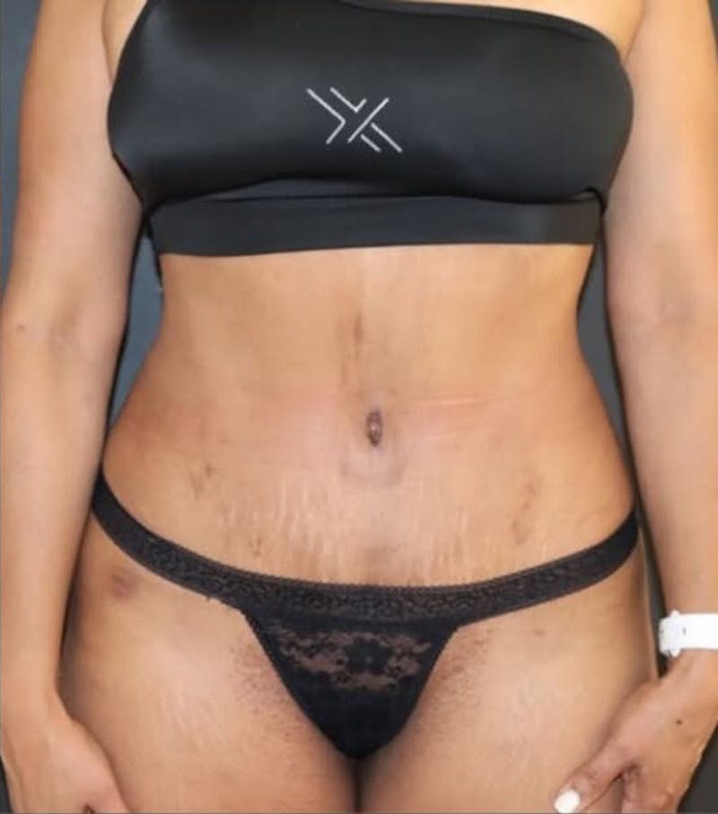 Tummy Tuck Before & After Gallery - Patient 366517 - Image 2