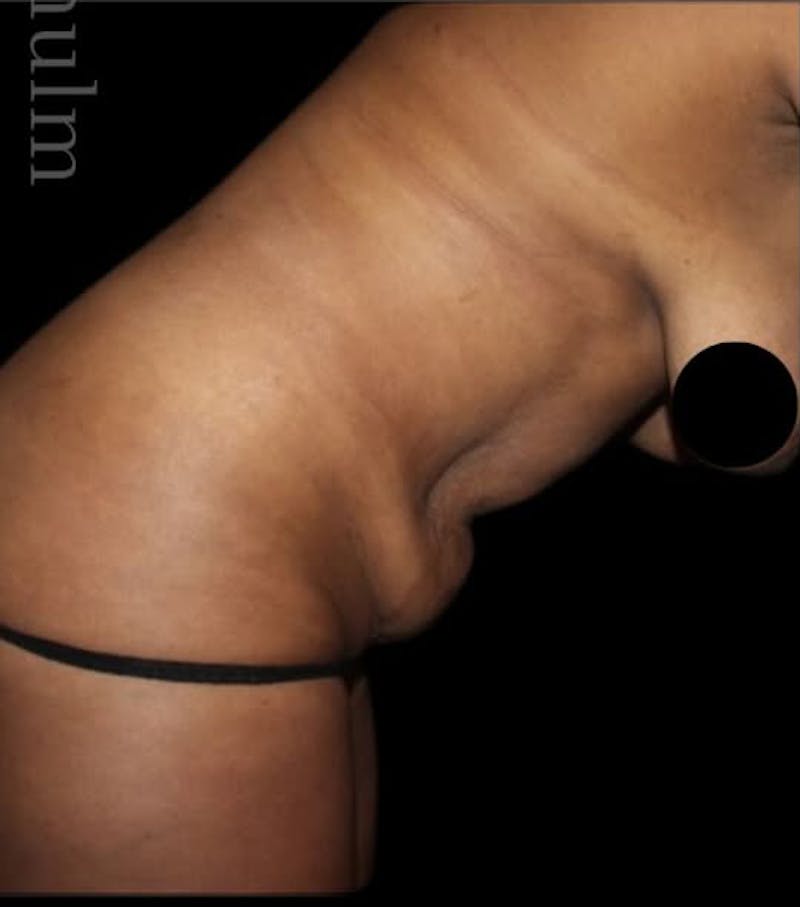 Tummy Tuck Before & After Gallery - Patient 366517 - Image 3