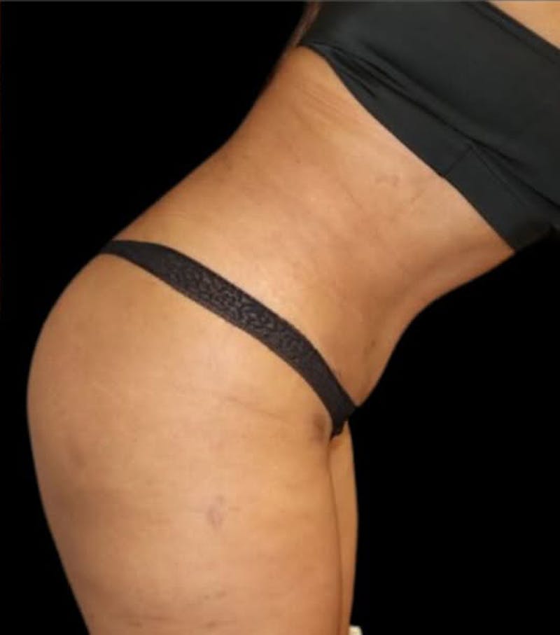 Tummy Tuck Before & After Gallery - Patient 366517 - Image 4