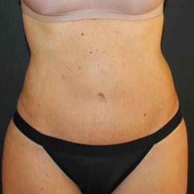 Tummy Tuck Before & After Gallery - Patient 303272 - Image 2