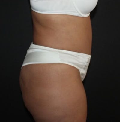 Tummy Tuck Before & After Gallery - Patient 283404 - Image 2