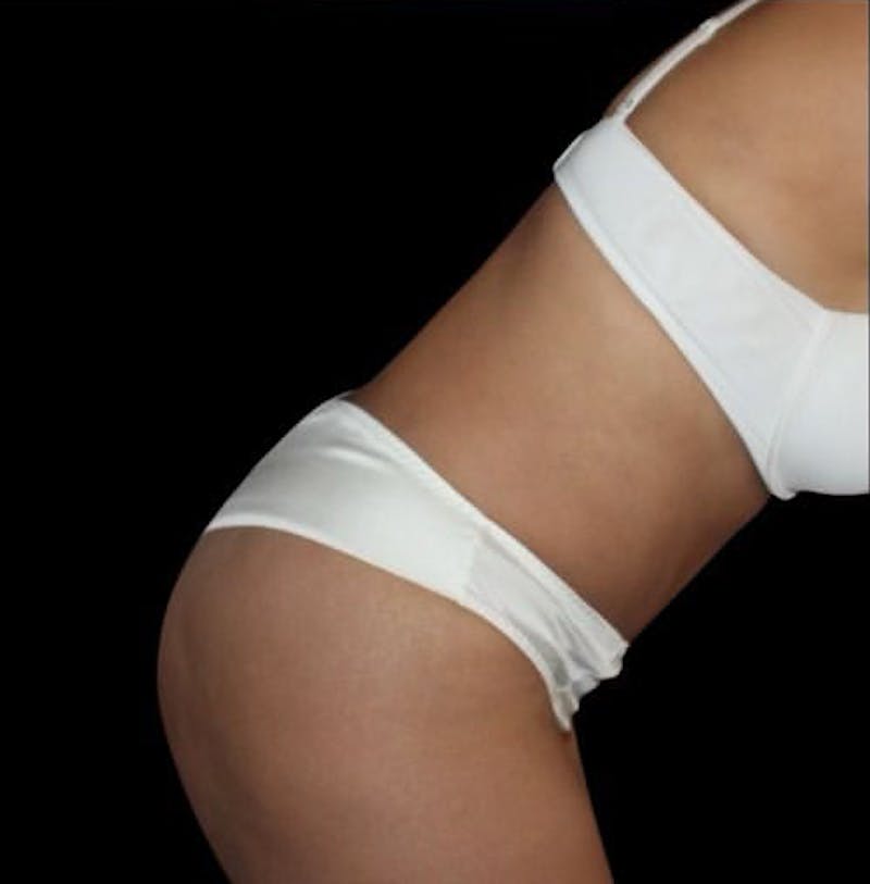 Tummy Tuck Before & After Gallery - Patient 283404 - Image 4