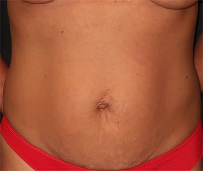 Tummy Tuck Before & After Gallery - Patient 834690 - Image 1