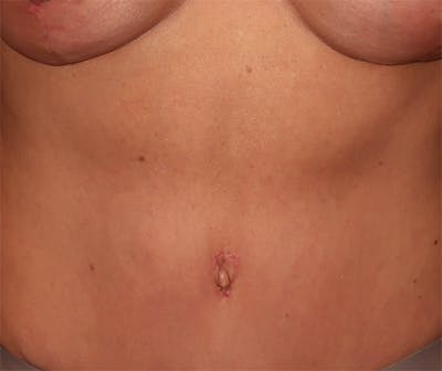 Tummy Tuck Before & After Gallery - Patient 834690 - Image 2