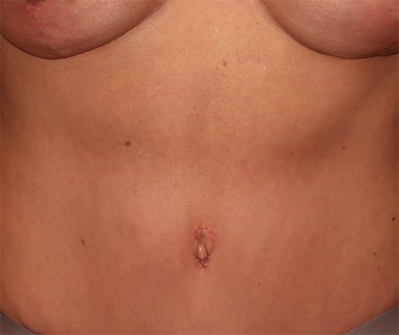Tummy Tuck Before & After Gallery - Patient 834690 - Image 2