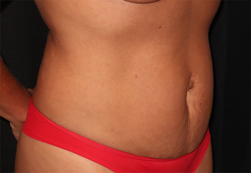 Tummy Tuck Before & After Gallery - Patient 834690 - Image 3
