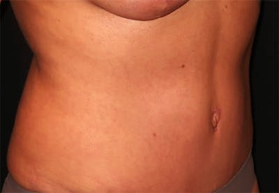 Tummy Tuck Before & After Gallery - Patient 834690 - Image 2