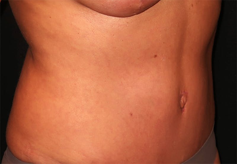 Tummy Tuck Before & After Gallery - Patient 834690 - Image 4