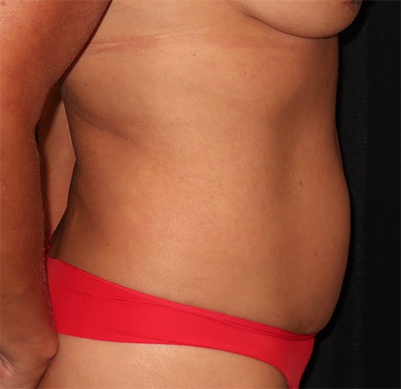 Tummy Tuck Before & After Gallery - Patient 834690 - Image 5