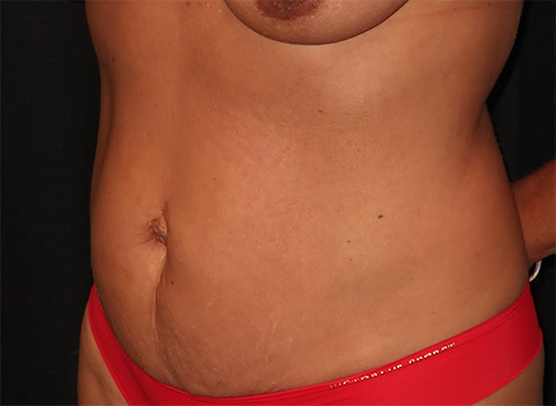 Tummy Tuck Before & After Gallery - Patient 834690 - Image 7