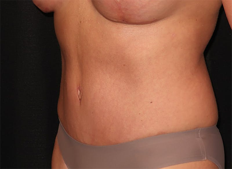 Tummy Tuck Before & After Gallery - Patient 834690 - Image 8