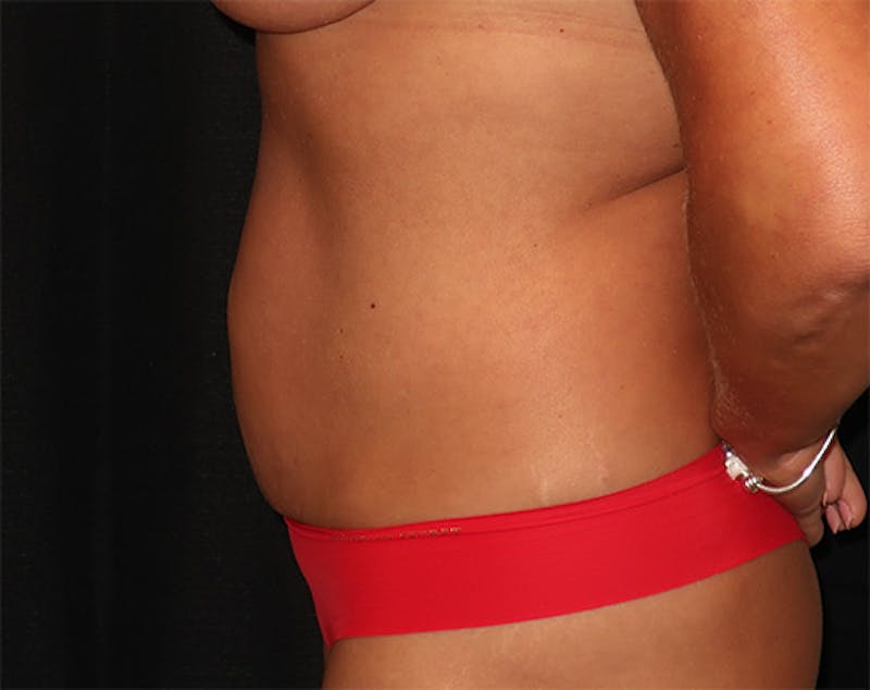 Tummy Tuck Before & After Gallery - Patient 834690 - Image 9