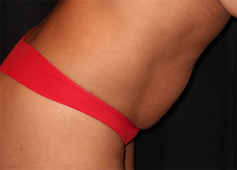 Tummy Tuck Before & After Gallery - Patient 834690 - Image 11