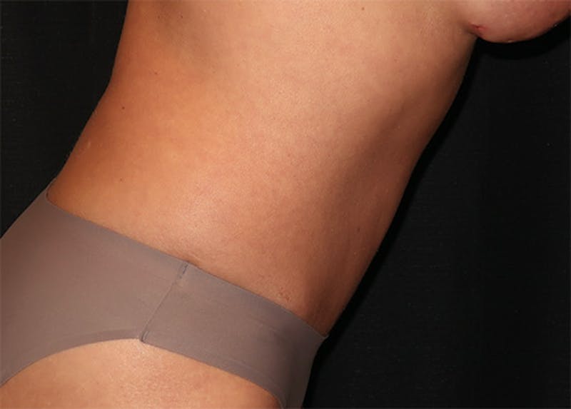 Tummy Tuck Before & After Gallery - Patient 834690 - Image 12