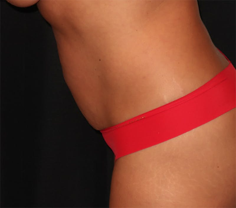 Tummy Tuck Before & After Gallery - Patient 834690 - Image 13