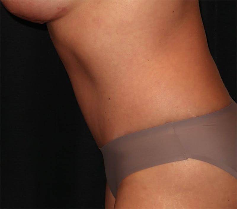 Tummy Tuck Before & After Gallery - Patient 834690 - Image 14