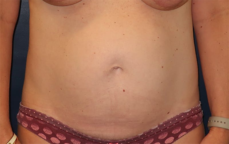 Tummy Tuck Before & After Gallery - Patient 296482 - Image 1