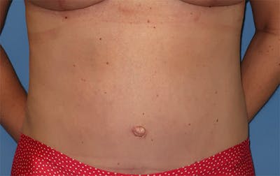 Tummy Tuck Before & After Gallery - Patient 296482 - Image 2