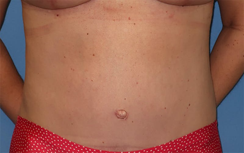 Tummy Tuck Before & After Gallery - Patient 296482 - Image 2