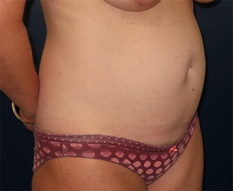 Tummy Tuck Before & After Gallery - Patient 296482 - Image 3