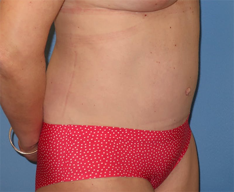 Tummy Tuck Before & After Gallery - Patient 296482 - Image 4