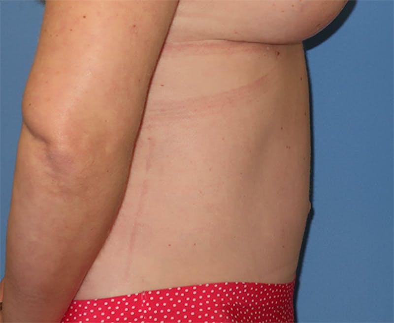 Tummy Tuck Before & After Gallery - Patient 296482 - Image 6