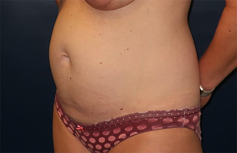 Tummy Tuck Before & After Gallery - Patient 296482 - Image 7