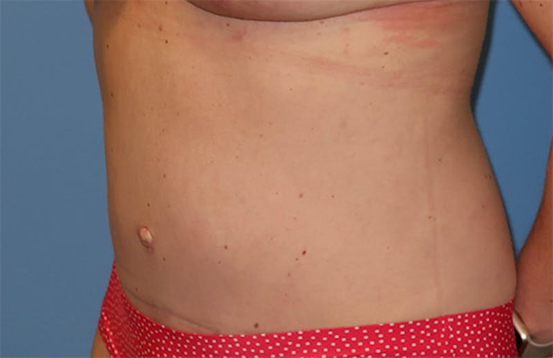Tummy Tuck Before & After Gallery - Patient 296482 - Image 8