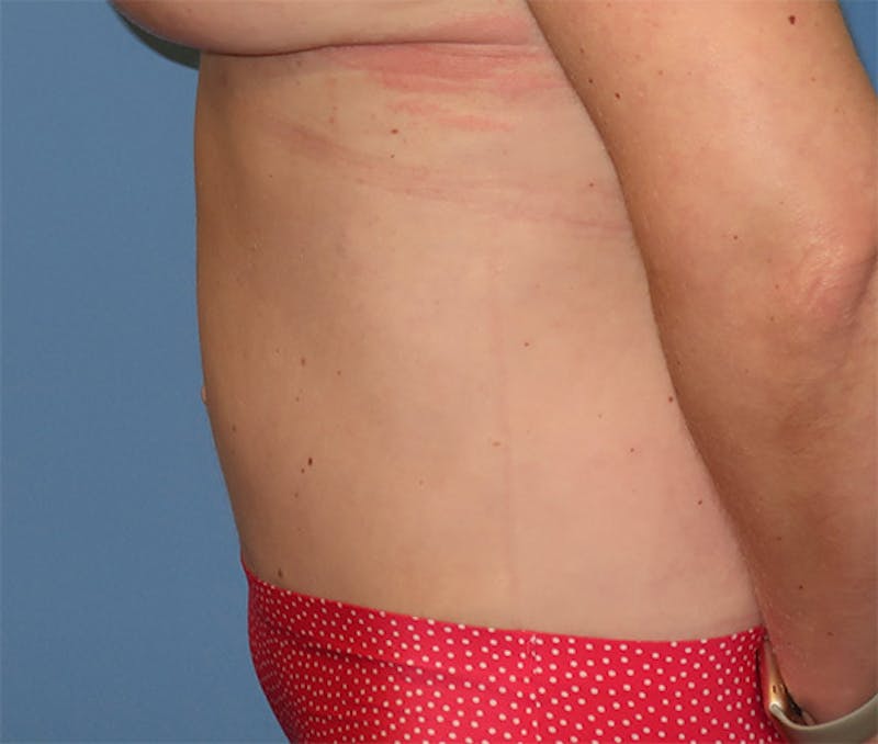 Tummy Tuck Before & After Gallery - Patient 296482 - Image 10