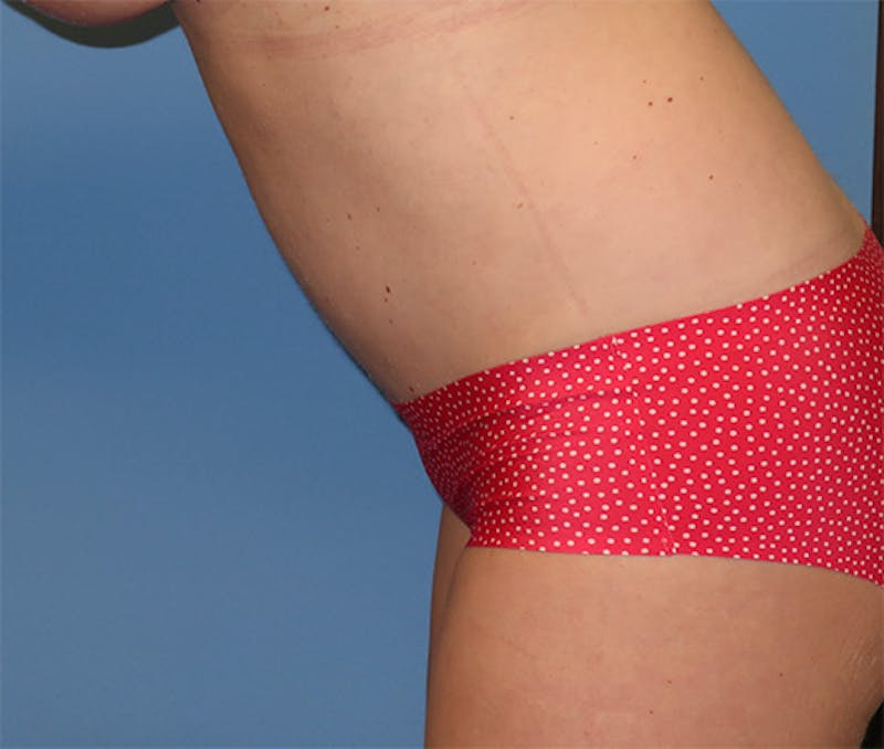 Tummy Tuck Before & After Gallery - Patient 296482 - Image 12