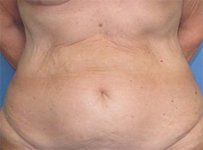 Tummy Tuck Before & After Gallery - Patient 354734 - Image 1