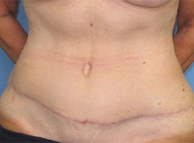 Tummy Tuck Before & After Gallery - Patient 354734 - Image 2