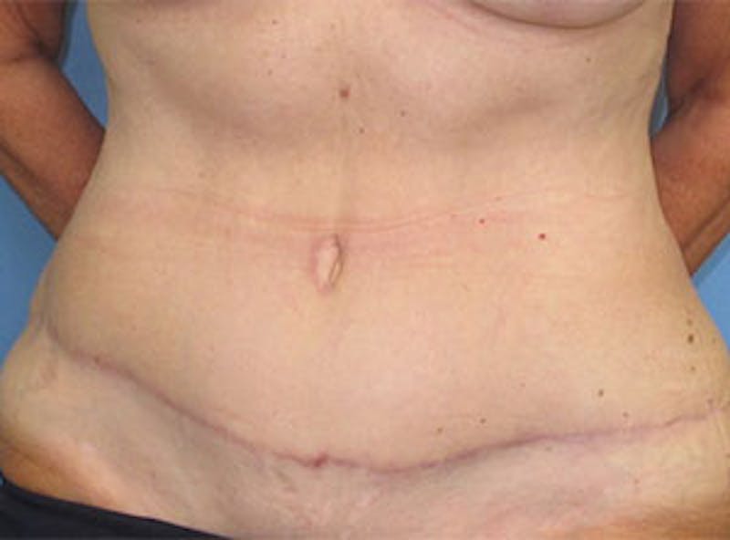 Tummy Tuck Before & After Gallery - Patient 354734 - Image 2