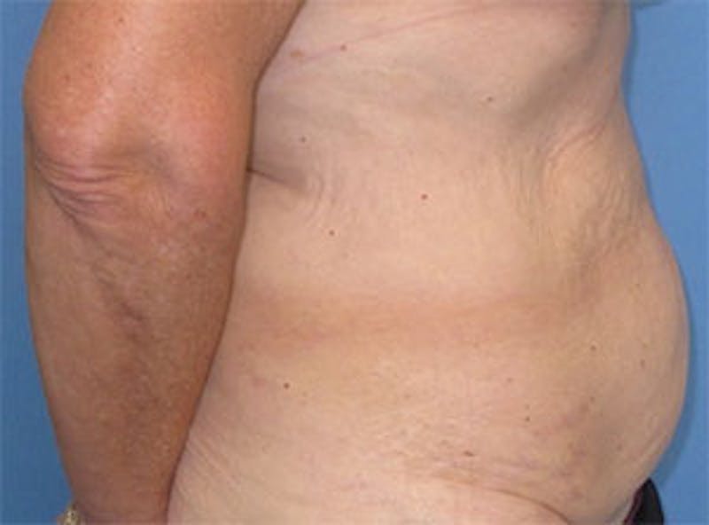 Tummy Tuck Before & After Gallery - Patient 354734 - Image 3