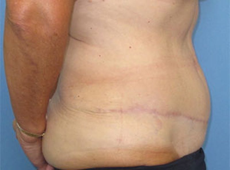 Tummy Tuck Before & After Gallery - Patient 354734 - Image 4