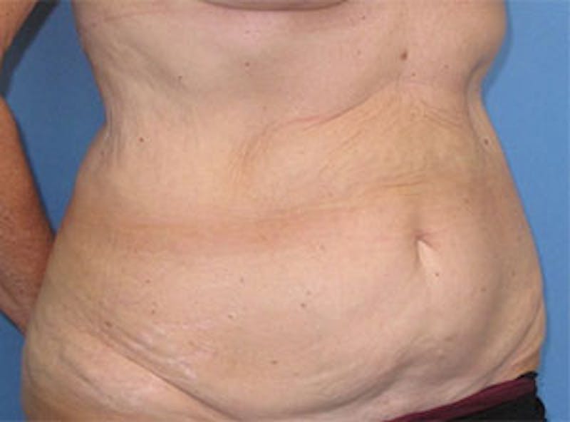 Tummy Tuck Before & After Gallery - Patient 354734 - Image 5