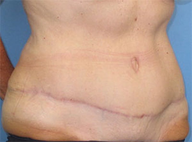Tummy Tuck Before & After Gallery - Patient 354734 - Image 6