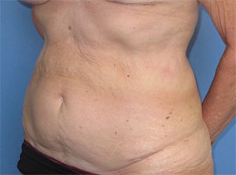 Tummy Tuck Before & After Gallery - Patient 354734 - Image 7