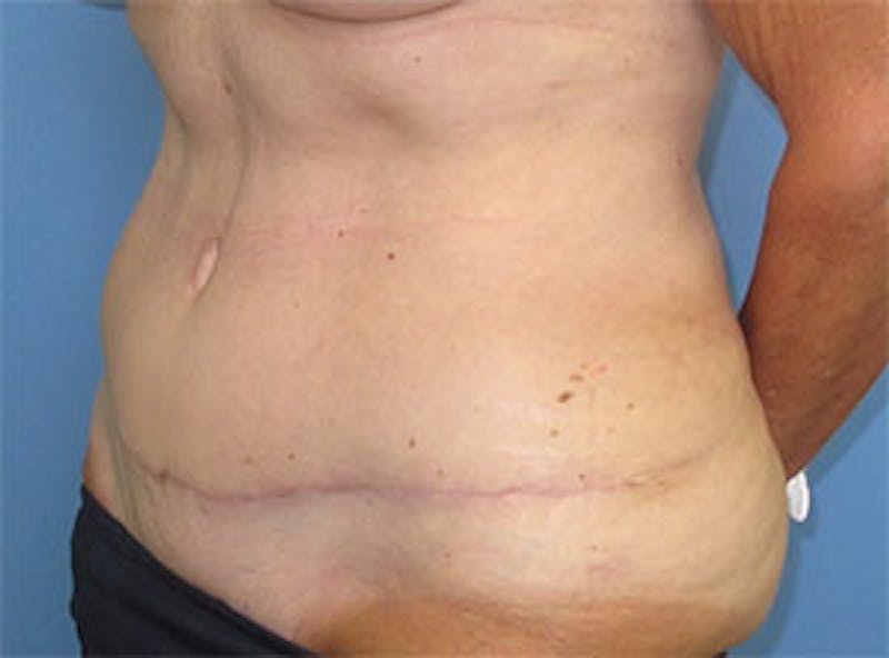 Tummy Tuck Before & After Gallery - Patient 354734 - Image 8