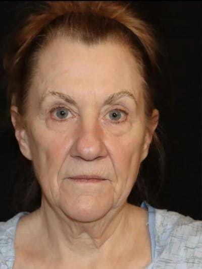 Face and Necklift Before & After Gallery - Patient 163590 - Image 1