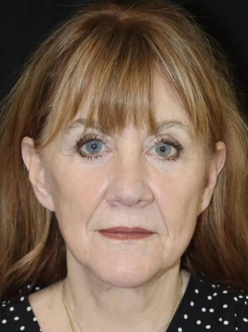 Face and Necklift Before & After Gallery - Patient 163590 - Image 2