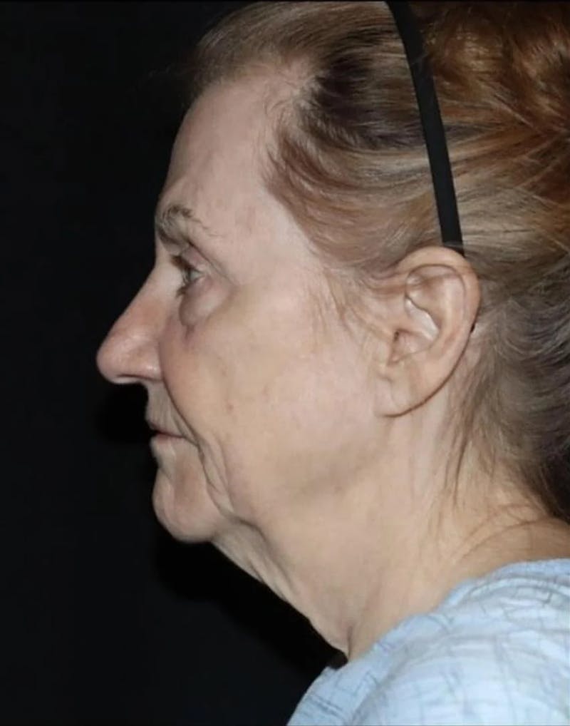 Face and Necklift Before & After Gallery - Patient 163590 - Image 3