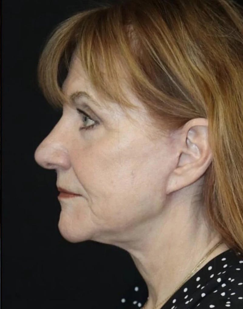 Face and Necklift Before & After Gallery - Patient 163590 - Image 4