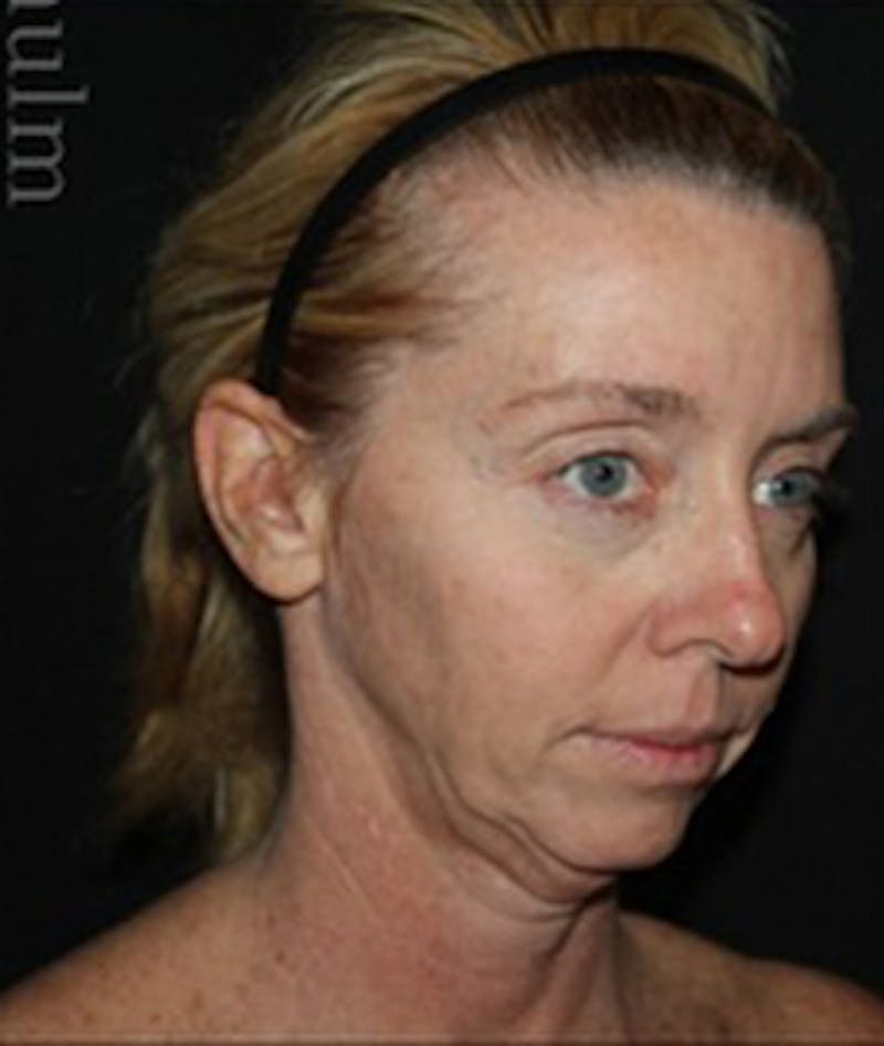 Face and Necklift Before & After Gallery - Patient 368217 - Image 1